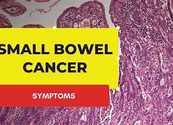 Image result for Rare Small Bowel Cancer