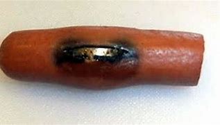 Image result for Botton Battery Burn