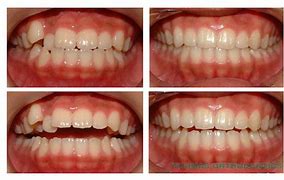 Image result for Removing 4 Teeth for Braces Before and After