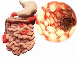 Image result for crohn