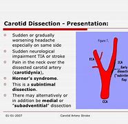 Image result for Carotid Artery Pain Left Side