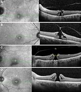 Image result for Retina Hole Progression