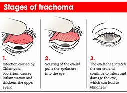 Image result for Trachomatis Eye