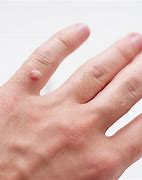Image result for Warts On Hands Fingers