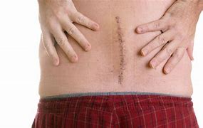 Image result for Back Surgery Scars