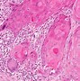 Image result for Squamous Cell Scalp