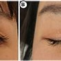 Image result for Double Eyelid Creation