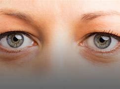 Image result for actomatopsia