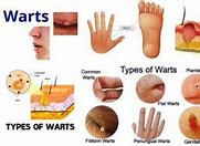 Image result for Different Wart Types