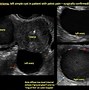 Image result for Ovarian Teratoma Dermoid Ultrasound