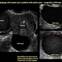 Image result for Left Ovarian Teratoma