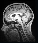 Image result for Autism Brain Scan