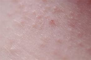 Image result for Molluscum Skin Rash