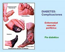 Image result for Pies Diabetes