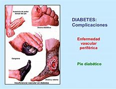 Image result for Pies Diabetes
