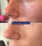 Image result for Cryotherapy Mole Removal Before and After