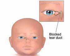 Image result for Blocked Eyelid Duct