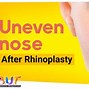 Image result for Nose Tip Swelling After Rhinoplasty