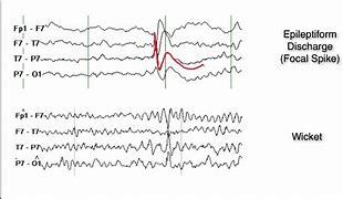 Image result for Wicket Spikes in EEG