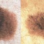 Image result for Sunspots On Black Skin