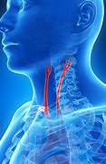 Image result for Carotid Artery Angioplasty
