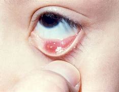 Image result for Wart On Eyelid