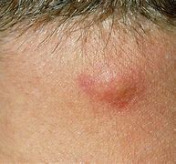 Image result for Sebaceous Cyst On Back of Neck