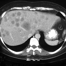 Image result for Carcinoid Tumor Small Intestine