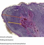 Image result for Papilloma in the Auricle