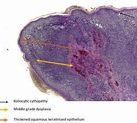 Image result for Squamous Papilloma Ear