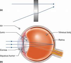 Image result for Right Eye Retina