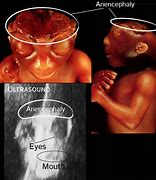 Image result for Anencephaly Cure