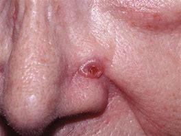 Image result for Basal Cell Carcinoma Nodular Type