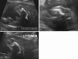 Image result for Proteus Syndrome Fetal Ultrasound