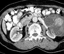 Image result for Bosniak Renal Cyst
