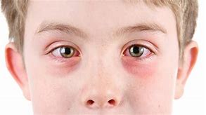 Image result for Eye Allergies in Children