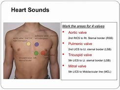 Image result for S3 Heart Sound Location