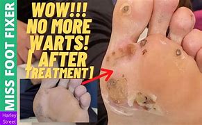 Image result for Foot Warts