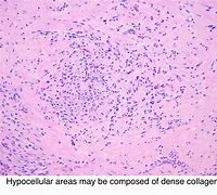 Image result for Ovarian Sclerosing Stromal Tumor