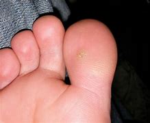 Image result for Home Remedies for Plantar Warts