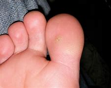 Image result for Types of Warts On Body