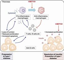 Image result for Type 1 and 2 Diabetes Difference