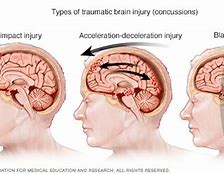 Image result for Back of Head Injury Concussion