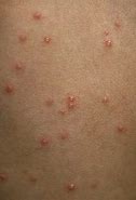 Image result for Chicken Pox On Dark Skin