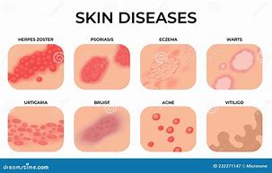 Image result for All Skin Diseases