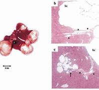 Image result for How Big Is 4 Centimeter Cyst