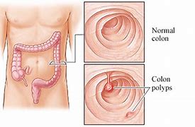 Image result for Average Size of Colon Polyps