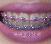Image result for Teal and Hot Pink Braces