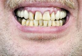 Image result for Gross Teeth