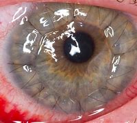 Image result for Eye Cornea Transplant